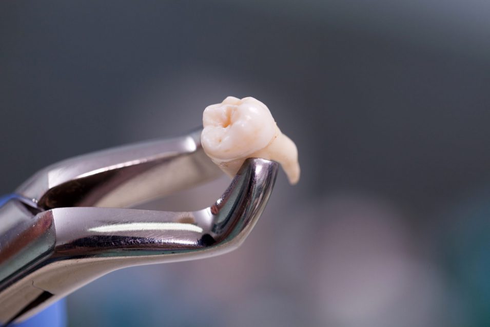 Dental equipment,tooth extraction Dental equipment for tooth extraction in Brantford