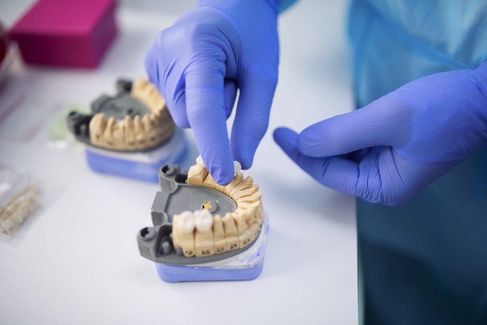 Dentist arranging zirconium teeth crowns. dentist showing a model of a dental crown in Brantford