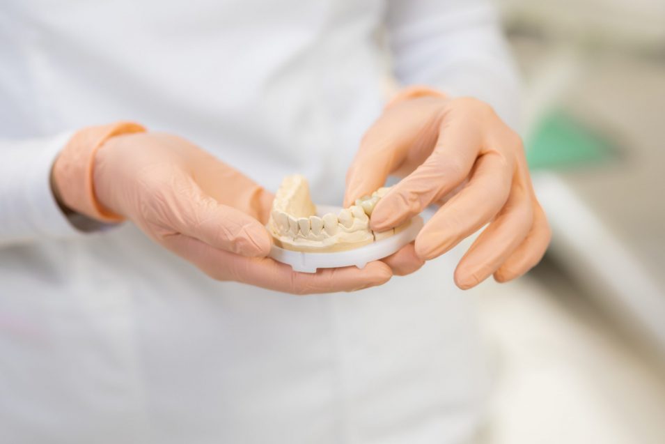 Dental plaster mould in the hands of the dentist custom made dental mould model of a dental bridge in Brantford shown by dentist