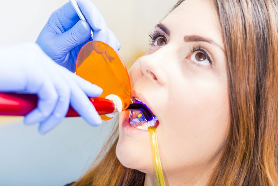 girl in the procedure receiving dental bonding restorative dentistry in Brantford