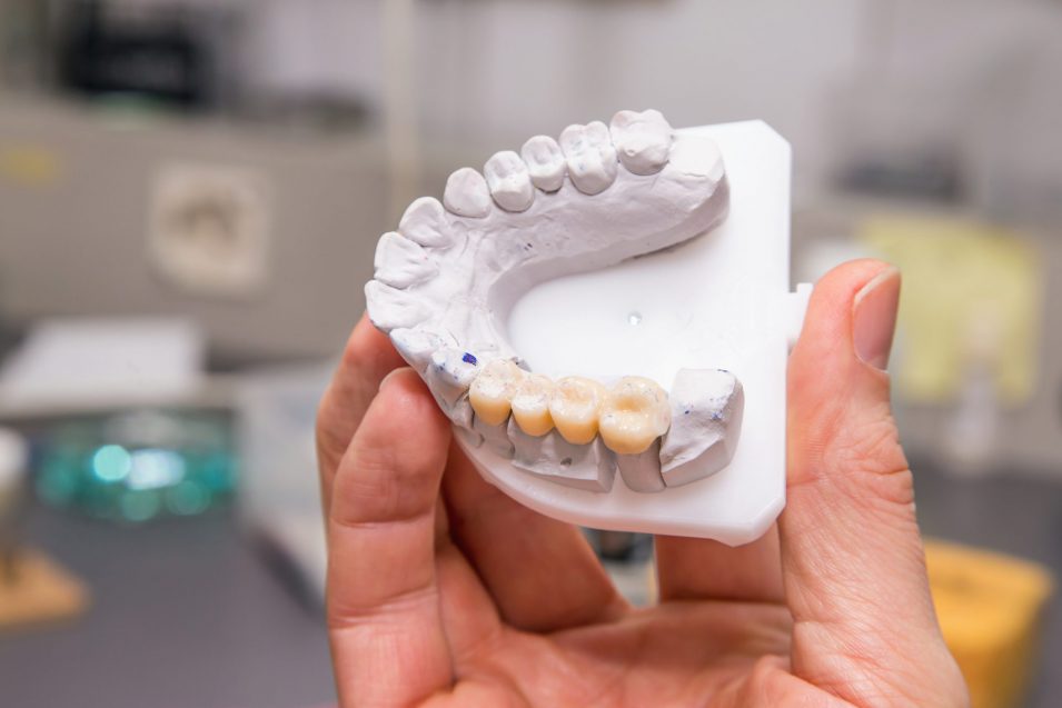 model of a dental bridge in Brantford held by a dentist